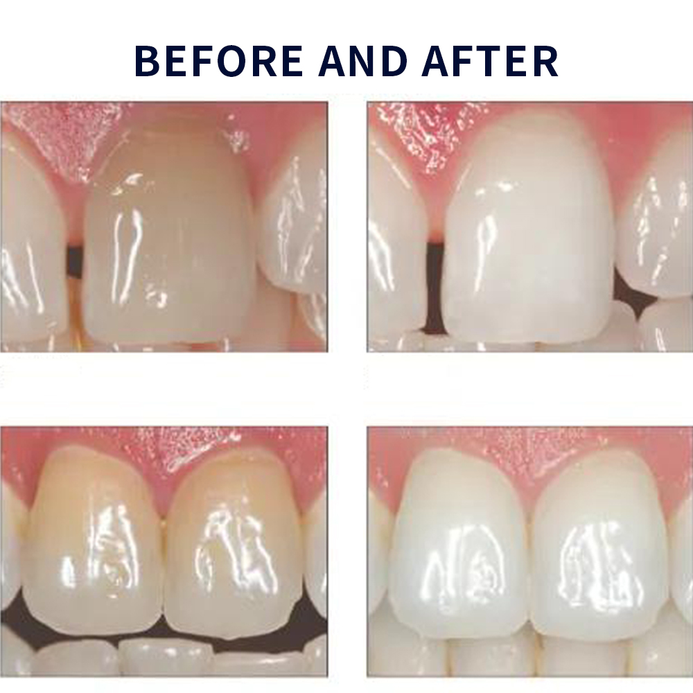 Opalescence Whitening 20% PF 2 - Teeth Whitening Before And After ulasan dan harga