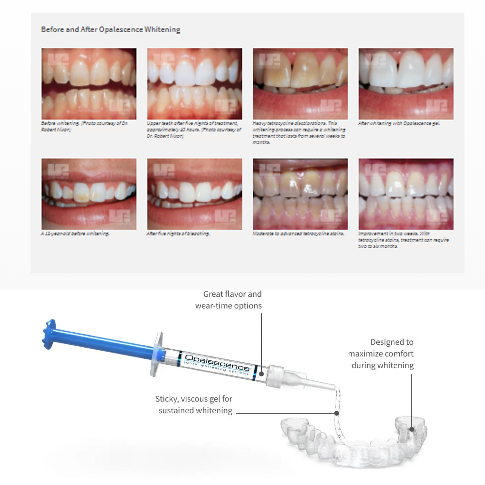 Opalescence Whitening 20% PF 2 - Teeth Whitening Before And After ulasan dan harga