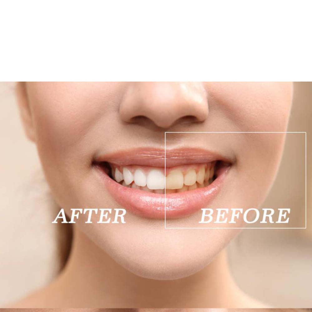 Top Quality Peroxide Teeth Whi - Teeth Whitening Bleach ulasan dan harga